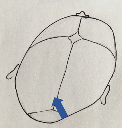 plagiocéphalies du nouveau-né (tête aplatie)